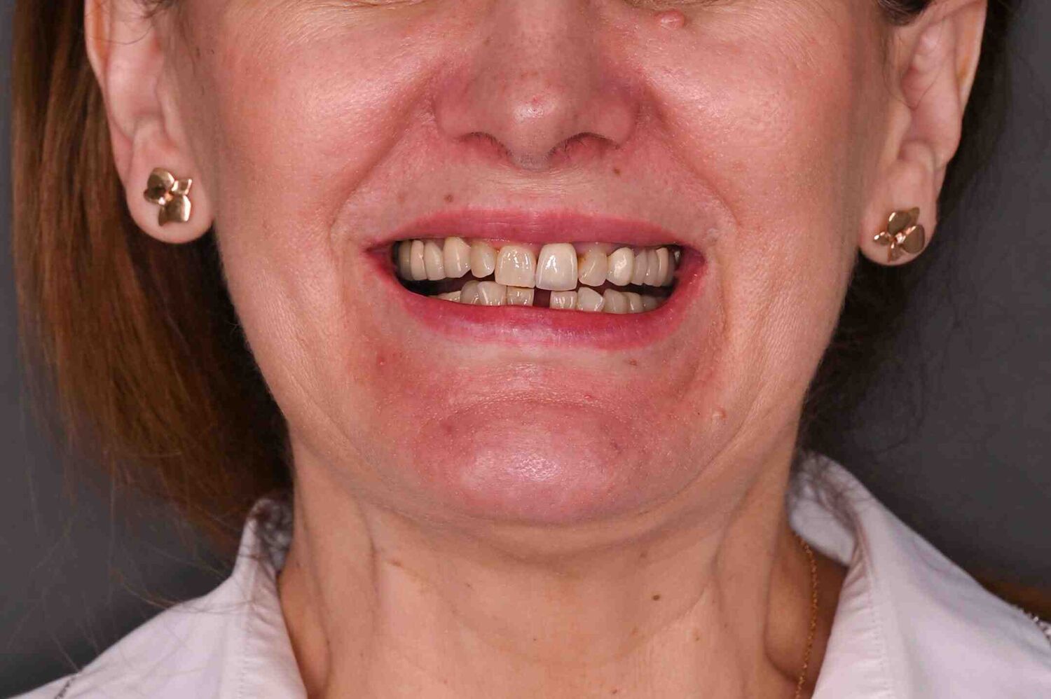 Pacient Clinica Dr. Alin Odor - Rezultat Implantologie